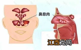 鼻息肉手术后能买重疾险吗？