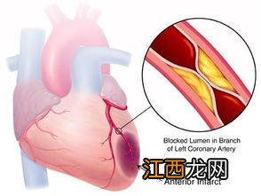轻微心肌缺血可以买哪些保险?