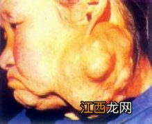 腮腺混合瘤能买保险吗？