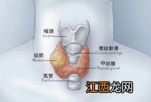 甲状腺癌是重疾吗？