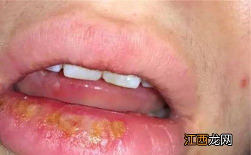 嘴唇疱疹结痂了还要擦药吗-嘴唇疱疹结痂了多久能好