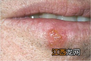 嘴唇起疱疹之後幹巴巴的塗抹啥-嘴唇起疱疹之後幹巴巴的爲什麽