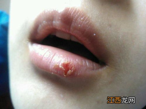 嘴唇起疱疹之後幹巴巴的塗抹啥-嘴唇起疱疹之後幹巴巴的爲什麽