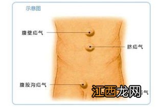 疝气手术影响重疾险投保吗？