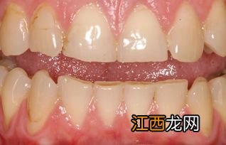 牙釉质脱落一点点要紧吗-牙釉质脱落早期图片
