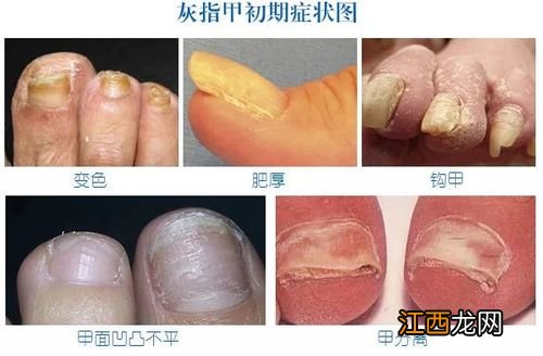 脚上灰指甲的危害性有多严重-灰指甲78年了长期不治会怎样