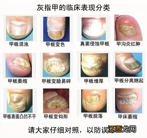 怎样识别灰指甲-灰指甲各个阶段图片