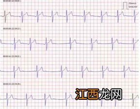 三岁宝宝窦性心律不齐买保险会被拒吗？