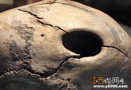 古代人有开颅手术吗 古代人治疗脑科疾病的方法