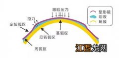 OK镜停戴一个月度数会加深吗-ok镜停戴一个月度数有影响吗