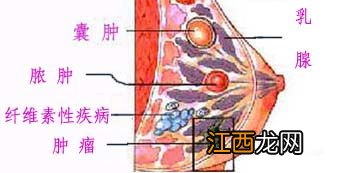 乳腺囊肿重疾险理赔吗？