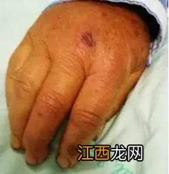 肺结核为啥不能吃茄子-肺结核吃茄子过敏了怎么办