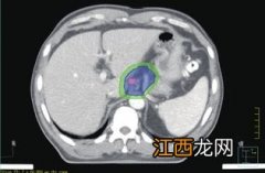 泰康惠健康里包含淋巴结吗？