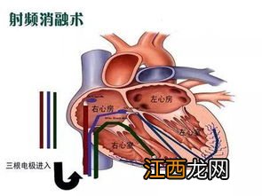 千万不要做心脏射频消融有什么说法-心脏射频消融术是个坑吗