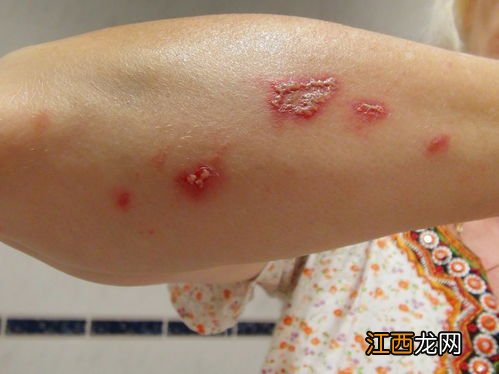 隐翅虫留下的疤是永久的吗-隐翅虫疤痕多久消掉