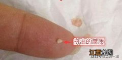 闭口不去针清根本好不了真的假的-美容院针清闭口管用吗