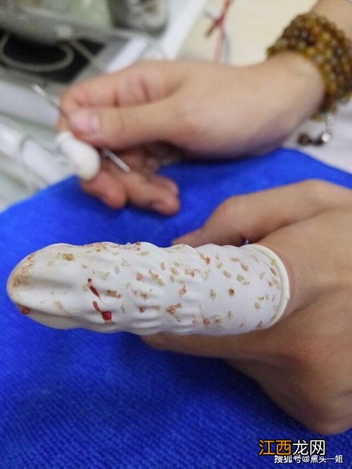 经常针清闭口粉刺好吗-针清能彻底治好痘痘吗