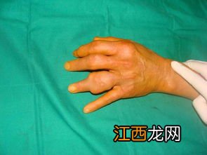 长生露可以治痛风吗-长生露到底好不好