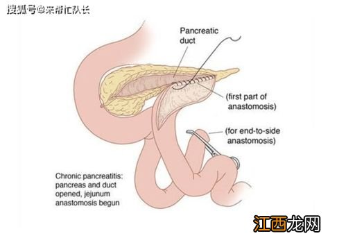 诊断胰腺炎但一直不疼严重吗-胰腺炎能吃的菜谱大全