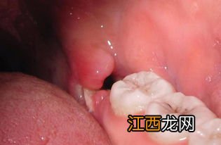 拔牙后冰敷多久拿开多久后又冰敷-拔牙后冷敷间隔时间是多久