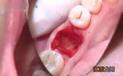 拔牙的止血棉会不会在里面不出来-拔牙的止血棉花会不会留在牙齿里