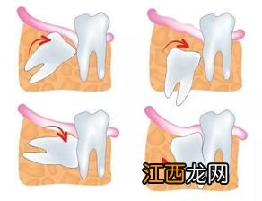 拔牙只能一颗一颗拔吗-拔牙一颗一颗拔还是两颗一起拔