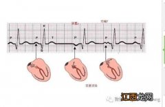 窦性心律不齐是心脏病早期吗 窦性心律不齐是正常现象吗