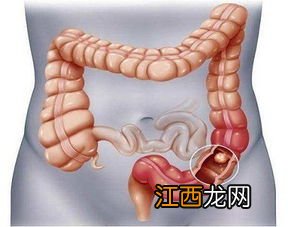 骨架大如何变成小骨架 注意饮食习惯