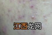 激光去黑眼圈有效吗