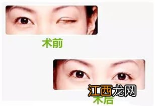 植入义眼需要多少钱呢2023-植入义眼台手术要住院多久