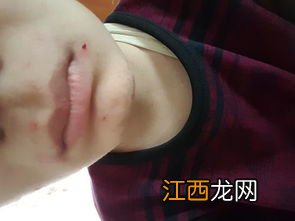 刮胡子刮出血会得破伤风吗-刮胡子刮出血会感染艾滋病吗