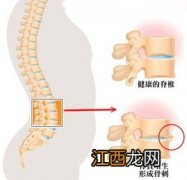 相互宝包含骨质增生吗？