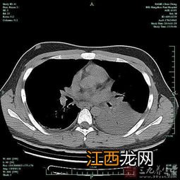 气管镜能把肺里浓痰洗净吗-怎么把肺里的浓痰排干净