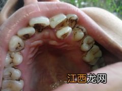 牙齿凹槽上面有黑色是蛀牙吗-牙齿凹槽上面有黑色洗牙能去除么