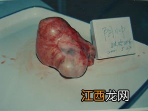 良性肿瘤保险理赔吗？