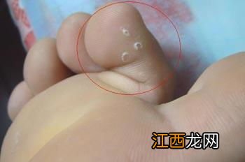 脚气治疗期间可以游泳吗-和有脚气的人一起游泳会有什么后果