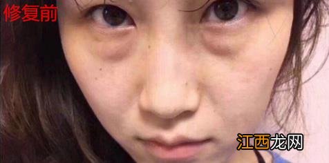 君雅笔记:眼袋过重,就会显得比真实年龄大,要如何修复眼袋呢?