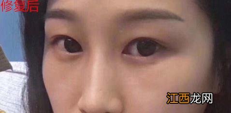 君雅笔记:眼袋过重,就会显得比真实年龄大,要如何修复眼袋呢?