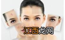 哪种手段治疗痘坑更有效呢?