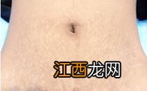 激光去妊娠纹的原理