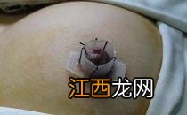 乳头内陷矫正后乳头有敏感度