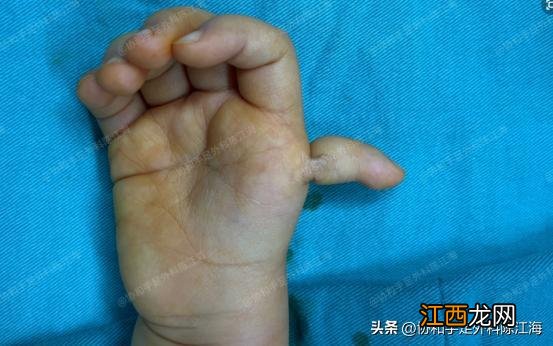 宝宝喜欢咬小揪揪,母亲却很难过,医生告知要切除拇指让人痛心