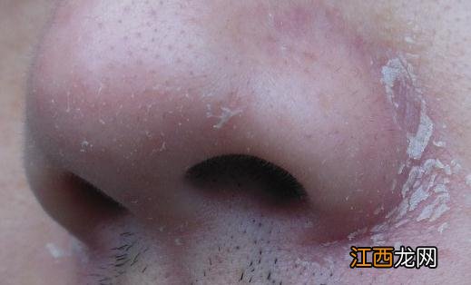 秋季鼻子两侧为何会干痒脱皮