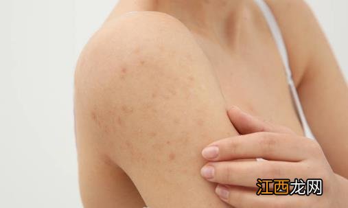 敏感性皮肤问答篇 皮肤过敏的十种防治措施