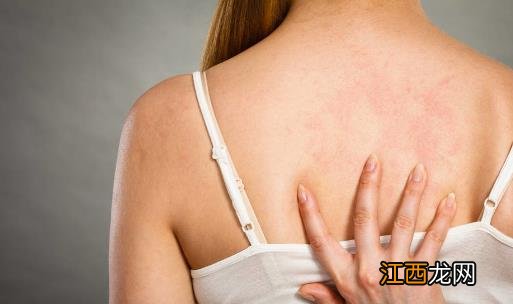 后背成长痘重灾区 背后长痘的解决措施及预防方法