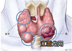两年前做的结节乳腺微创现在可以买保险吗?