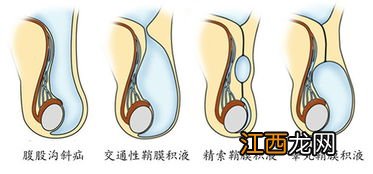 鞘膜积液商业保险报销吗？