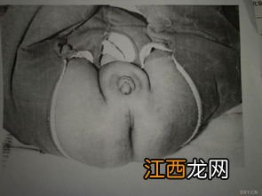 先天性尿道下裂能买保险吗？