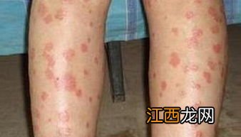 红斑狼疮能买女性防癌险吗？