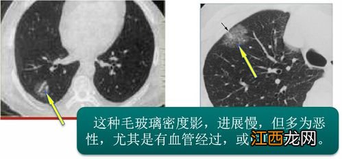 磨玻璃结节可以买保险吗？